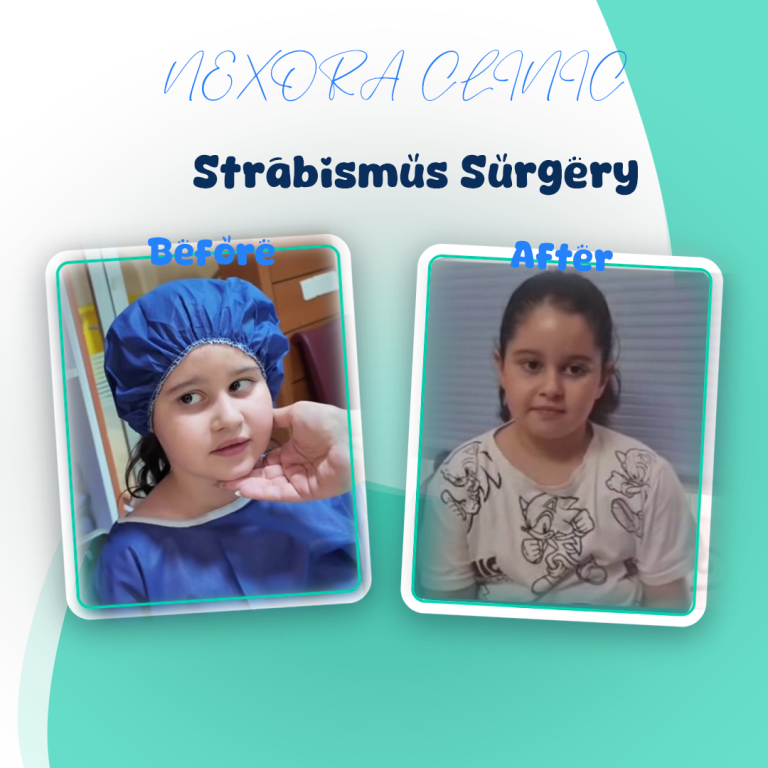 Strabismus Surgery4