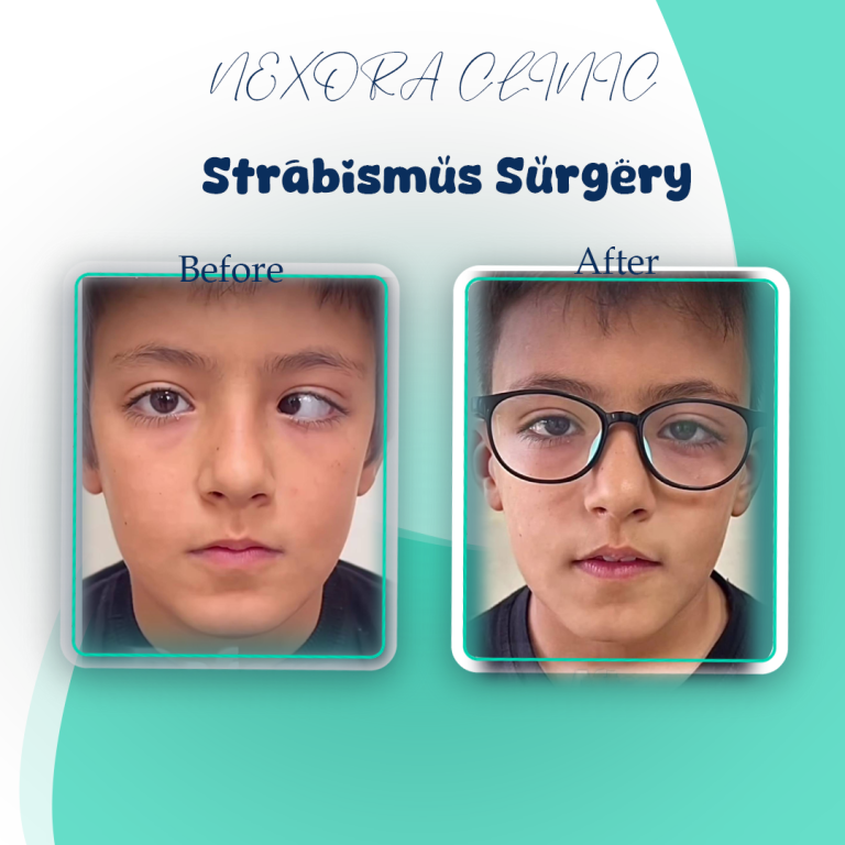 Strabismus Surgery5