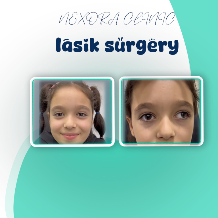 lasik surgery13
