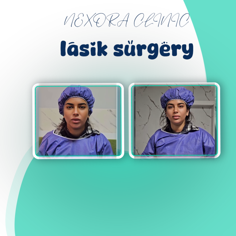 lasik surgery15