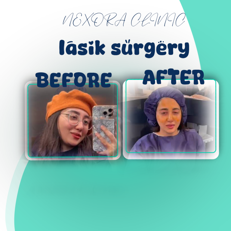 lasik surgery18