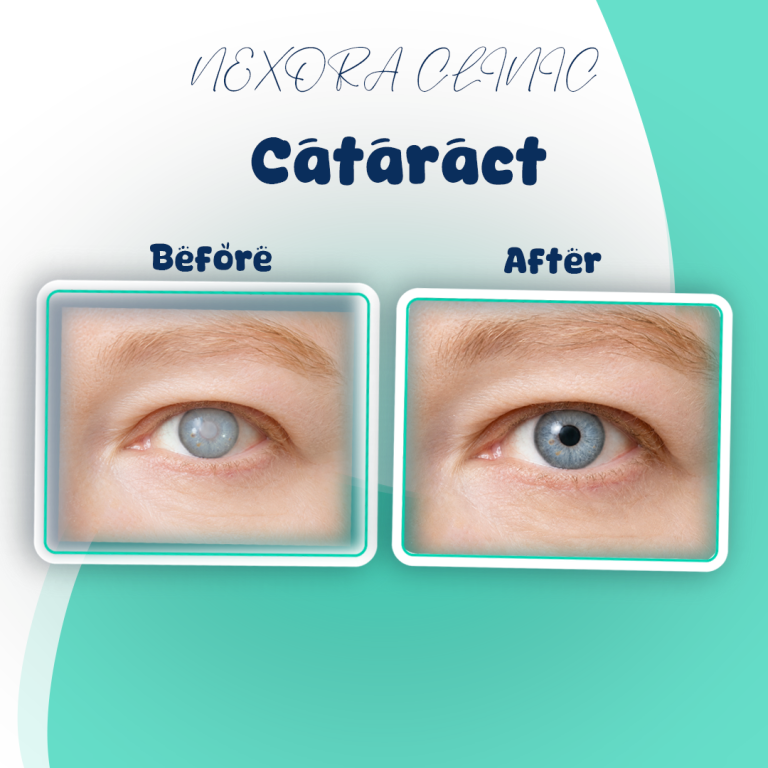 lasik surgery19