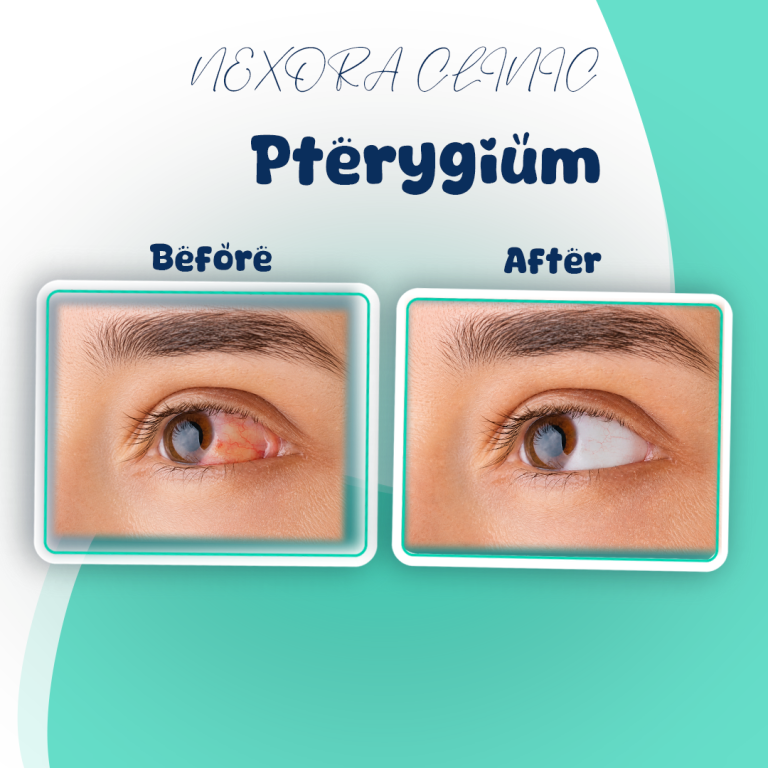 pterygium1