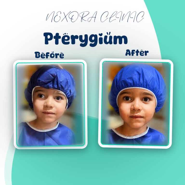 pterygium5