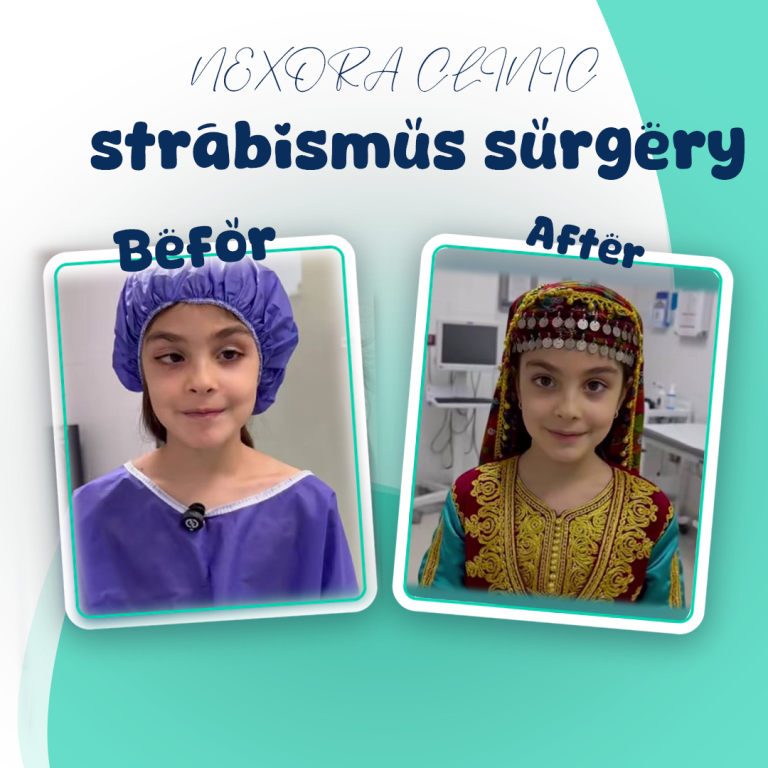 strabismus surgery1