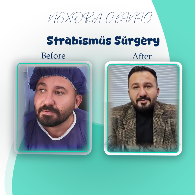strabismus surgery10