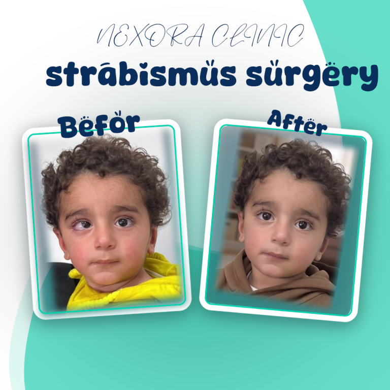 strabismus surgery2