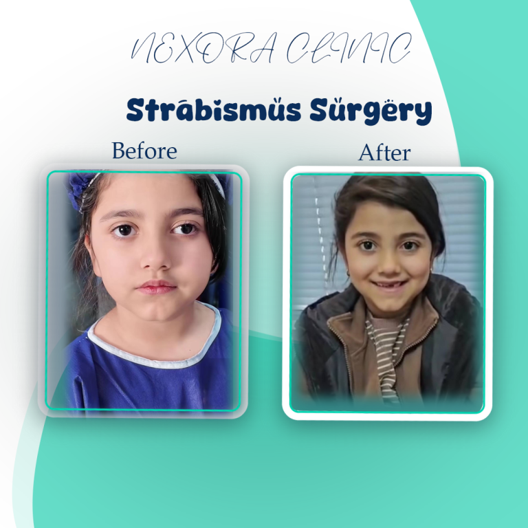 strabismus surgery7