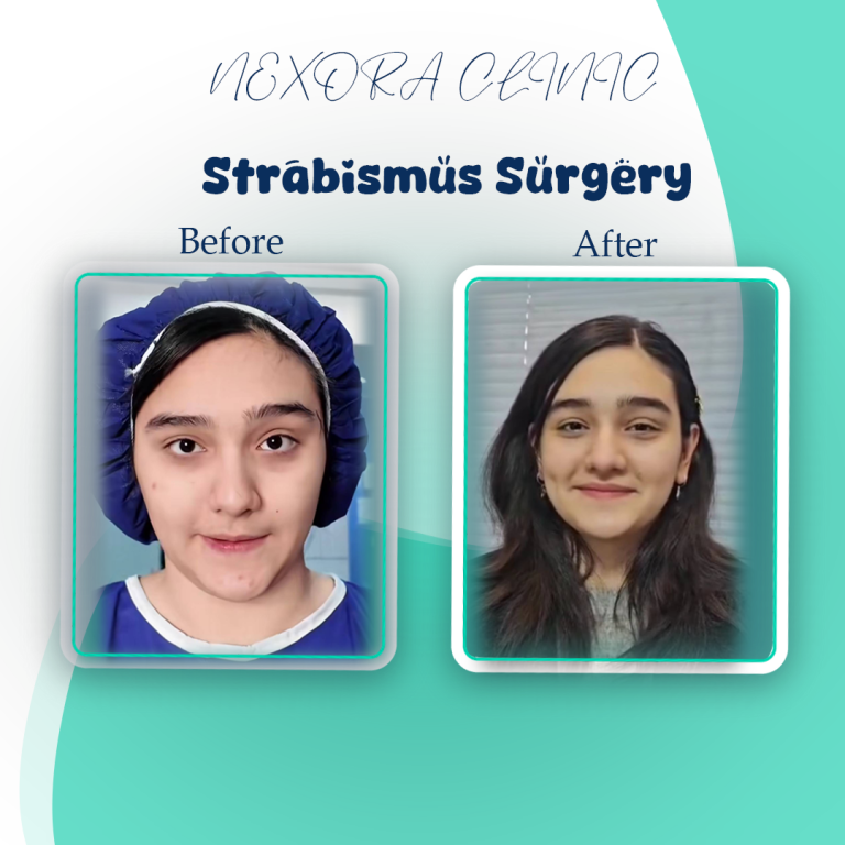strabismus surgery8