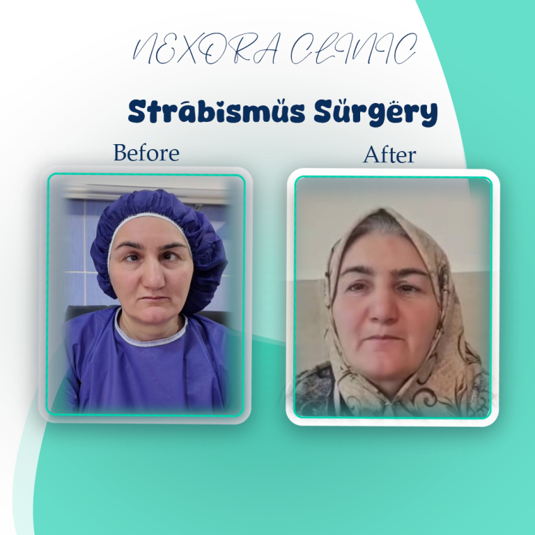 strabismus surgery9